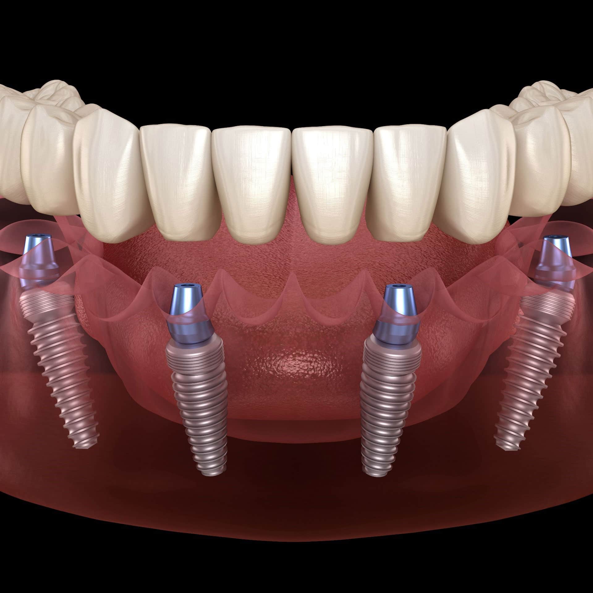 What are All on 4 & All on 6 Dental Implants?